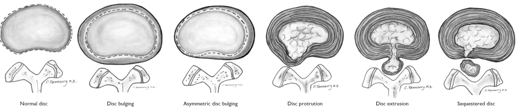 What is a herniated&nbsp;disc?