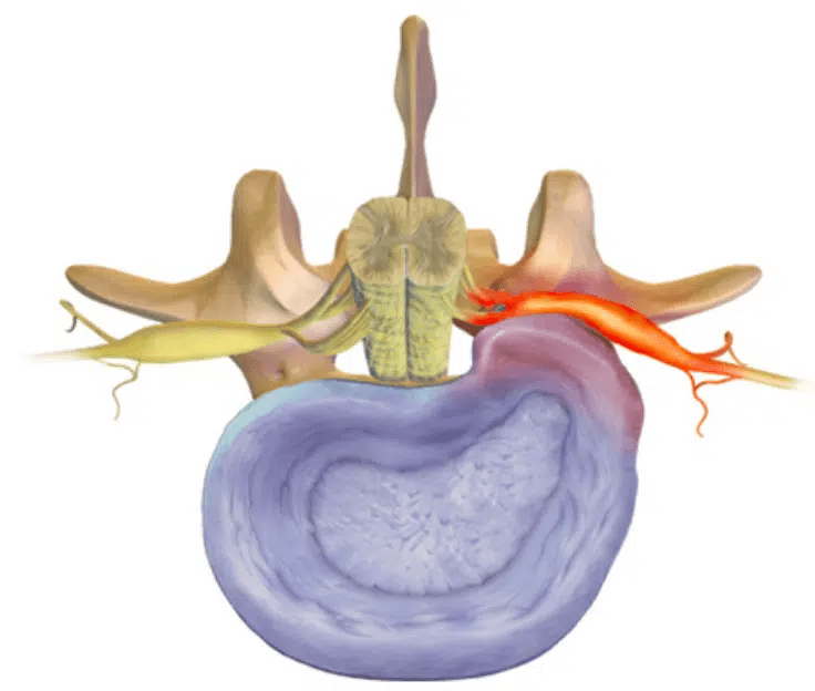 Are disc herniations&nbsp;painful?